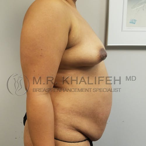 Mommy Makeover Gallery - Patient 3763111 - Image 7