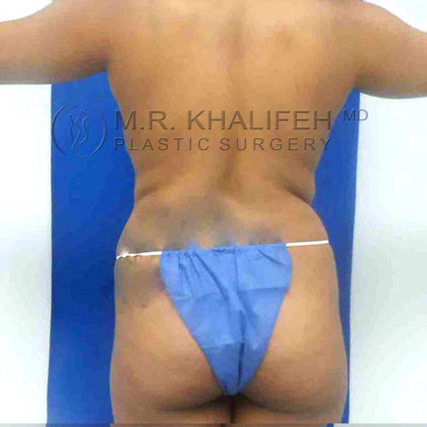 Brazilian Buttock Lift Gallery - Patient 3763294 - Image 1
