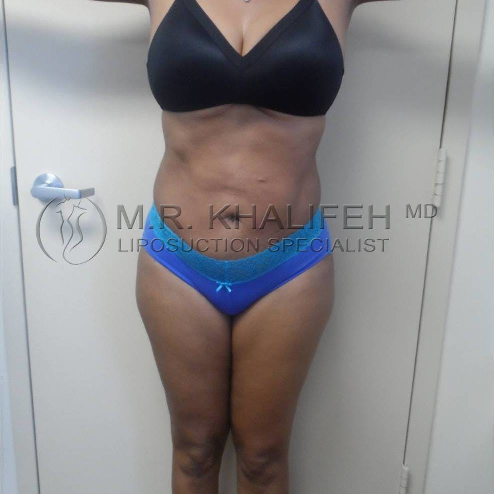 Abdominal Liposuction Gallery - Patient 94080928 - Image 2