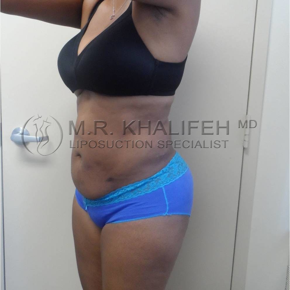 Abdominal Liposuction Gallery - Patient 94080928 - Image 6