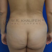 Brazilian Buttock Lift Gallery - Patient 3763573 - Image 1