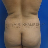 Brazilian Buttock Lift Gallery - Patient 3763632 - Image 1