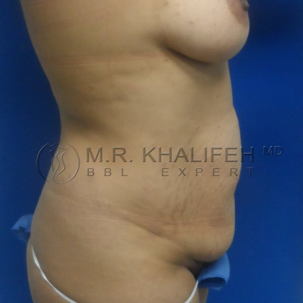 Brazilian Buttock Lift Gallery - Patient 3763632 - Image 9