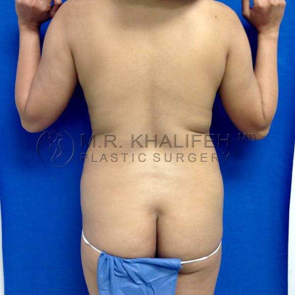Brazilian Buttock Lift Gallery - Patient 3763920 - Image 3