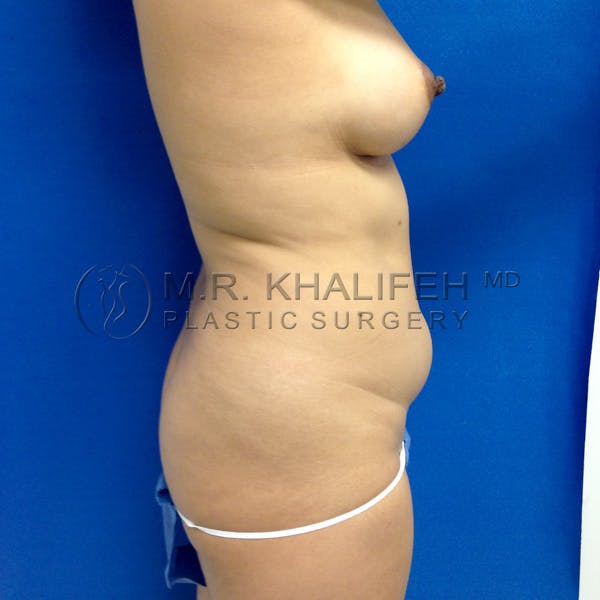 Brazilian Buttock Lift Gallery - Patient 3763920 - Image 5