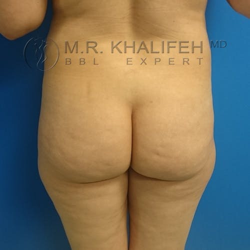Brazilian Buttock Lift Gallery - Patient 3763980 - Image 1