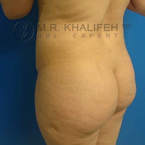 Brazilian Buttock Lift Gallery - Patient 3763980 - Image 9