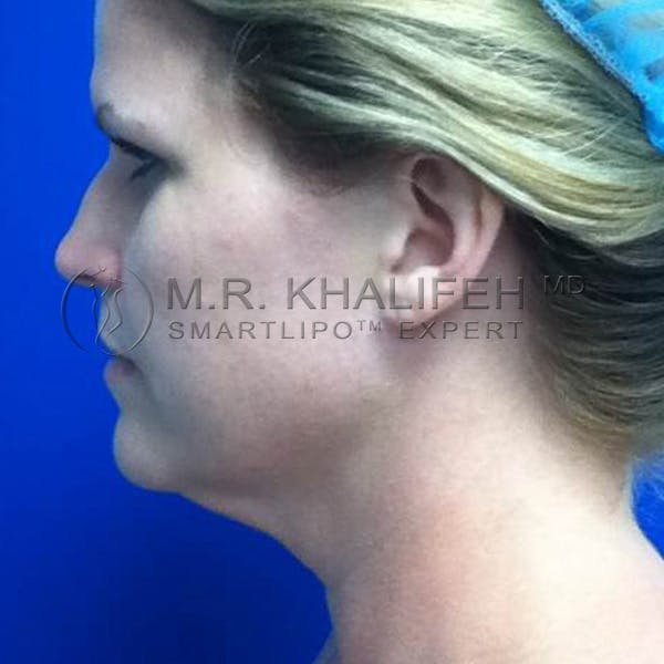 Chin & Neck Liposuction Gallery - Patient 3764005 - Image 3