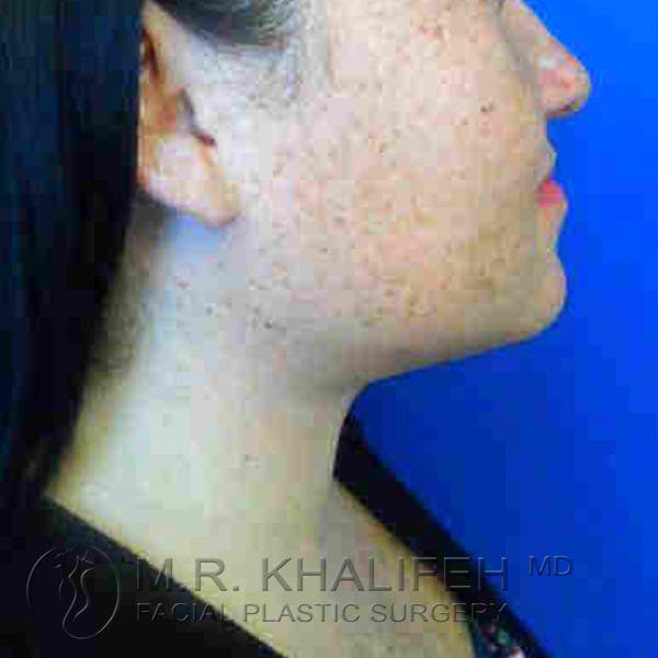 Chin & Neck Liposuction Gallery - Patient 3764052 - Image 2