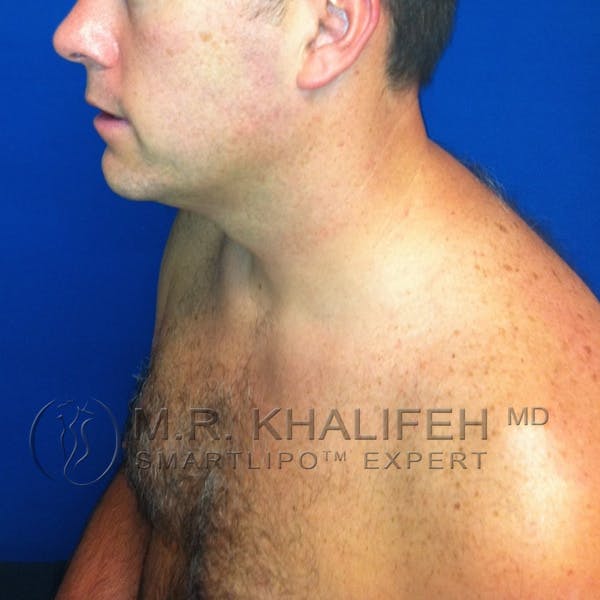 Chin & Neck Liposuction Gallery - Patient 3764088 - Image 3