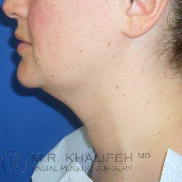 Chin & Neck Liposuction Gallery - Patient 3764171 - Image 3