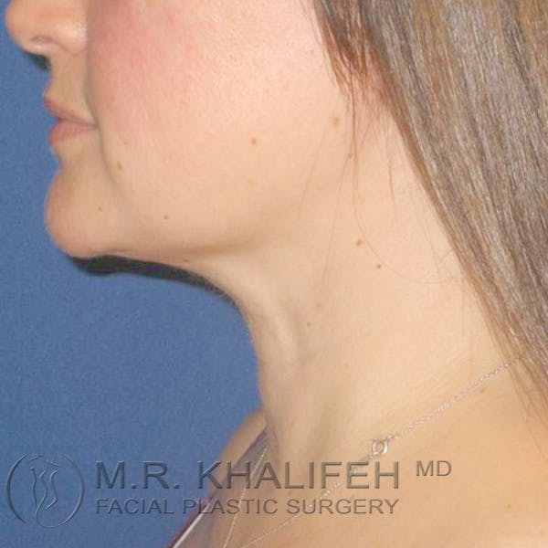 Chin & Neck Liposuction Gallery - Patient 3764171 - Image 4