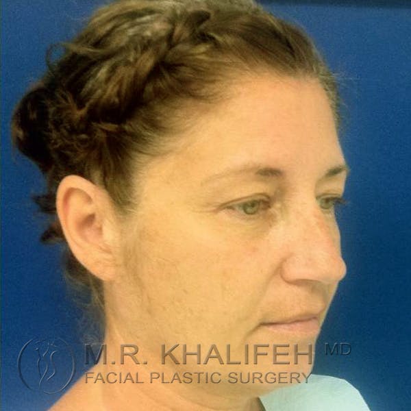Facelift Gallery - Patient 3764238 - Image 1