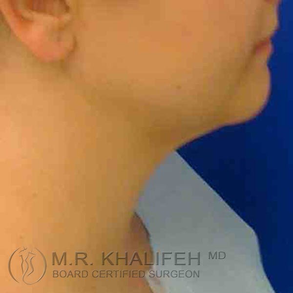 Chin & Neck Liposuction Gallery - Patient 3764228 - Image 1