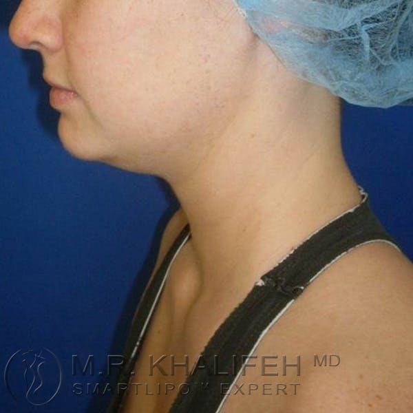 Chin & Neck Liposuction Gallery - Patient 3764239 - Image 1
