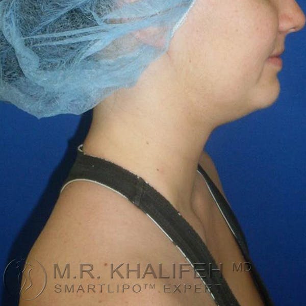 Chin & Neck Liposuction Gallery - Patient 3764239 - Image 3