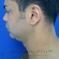 Chin & Neck Liposuction Gallery - Patient 3764246 - Image 1
