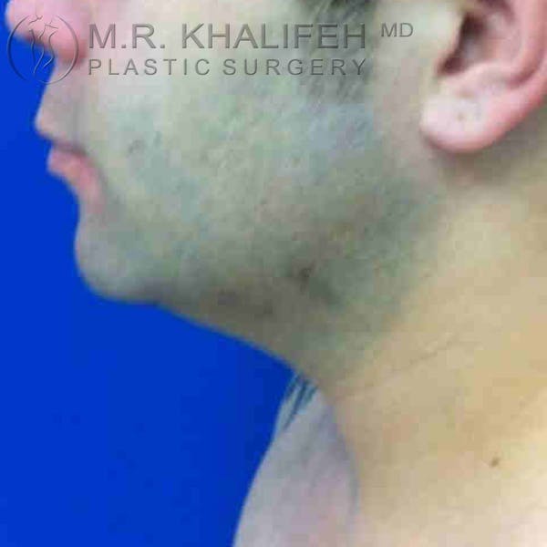 Chin & Neck Liposuction Gallery - Patient 3764248 - Image 3