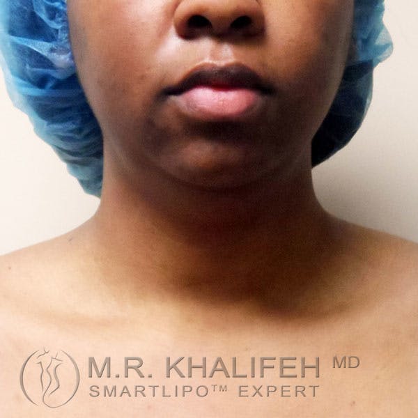 Chin & Neck Liposuction Gallery - Patient 3764251 - Image 1