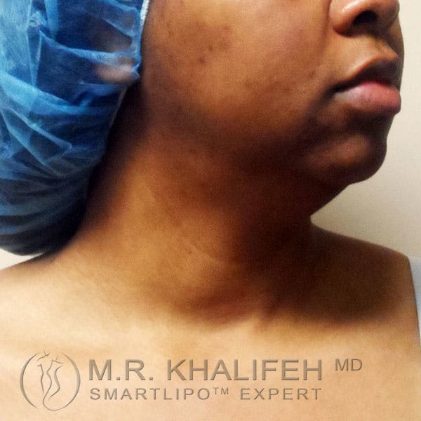 Chin & Neck Liposuction Gallery - Patient 3764251 - Image 3