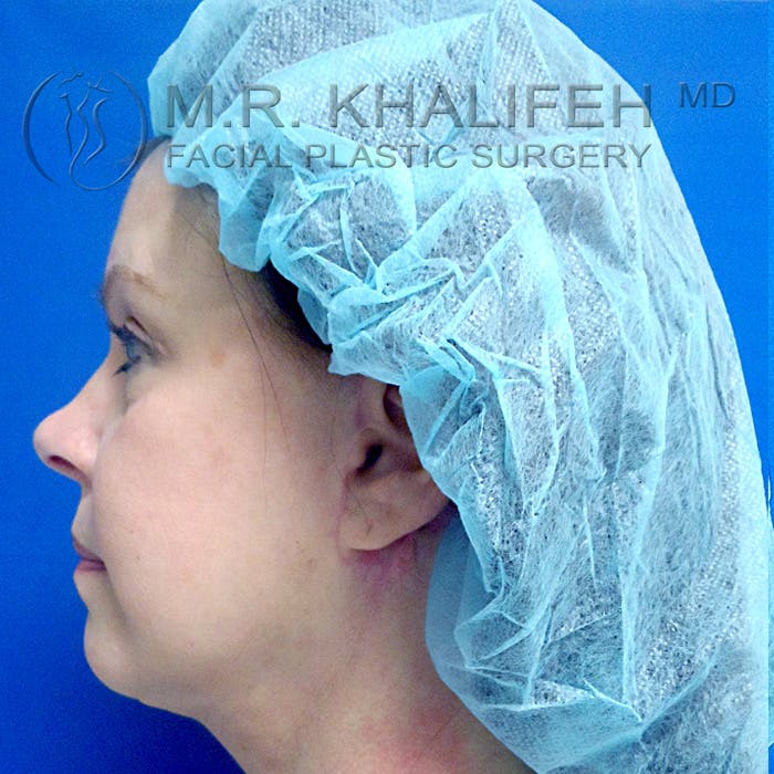 Facelift Gallery - Patient 3764274 - Image 10