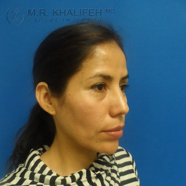 Fillers Gallery - Patient 3768588 - Image 3
