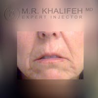 Fillers Gallery - Patient 3768636 - Image 1