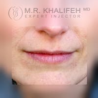 Fillers Gallery - Patient 3768718 - Image 1