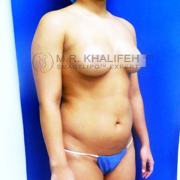 Abdominal Liposuction Gallery - Patient 3776250 - Image 3