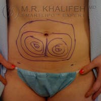 Abdominal Liposuction Gallery - Patient 3776300 - Image 1