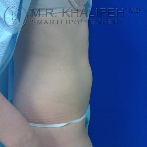 Abdominal Liposuction Gallery - Patient 3776300 - Image 5