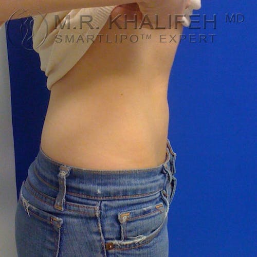 Abdominal Liposuction Gallery - Patient 3776300 - Image 6