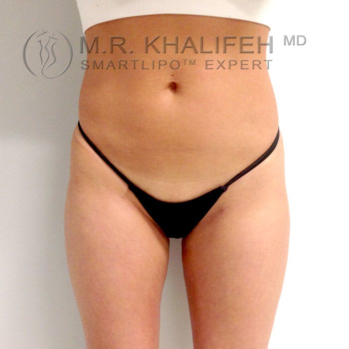 Abdominal Liposuction Gallery - Patient 3776361 - Image 2