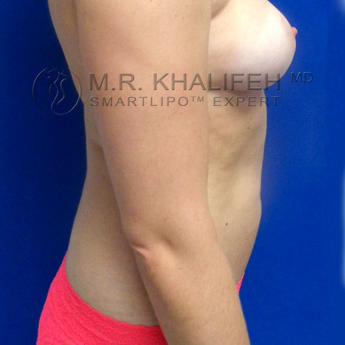 Abdominal Liposuction Gallery - Patient 3776462 - Image 3