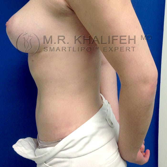 Abdominal Liposuction Gallery - Patient 3776462 - Image 8