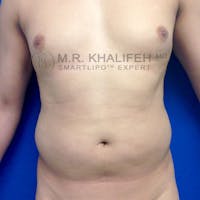 Abdominal Liposuction Gallery - Patient 3776566 - Image 1