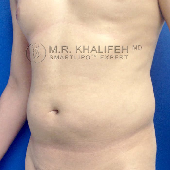 Abdominal Liposuction Gallery - Patient 3776566 - Image 3