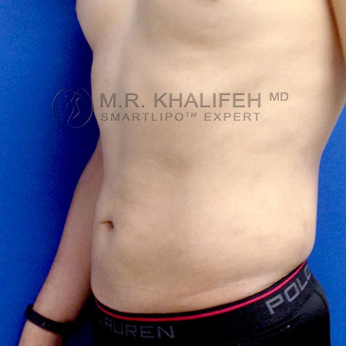 Abdominal Liposuction Gallery - Patient 3776566 - Image 4