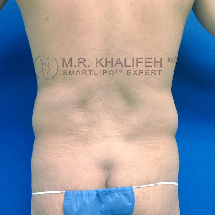 Abdominal Liposuction Gallery - Patient 3776566 - Image 7
