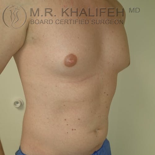 Gynecomastia Gallery - Patient 3776588 - Image 1