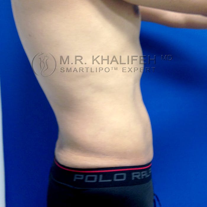 Abdominal Liposuction Gallery - Patient 3776566 - Image 10