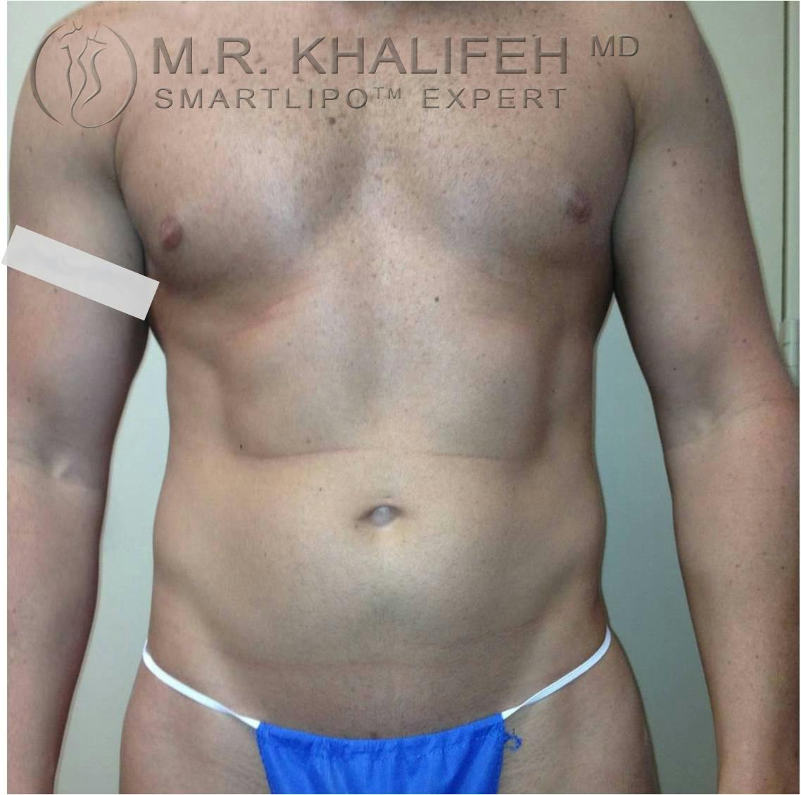 Male Liposuction Gallery - Patient 3776603 - Image 1