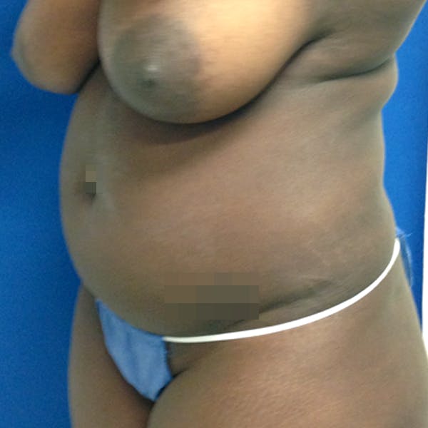 Abdominal Liposuction Gallery - Patient 3776647 - Image 3