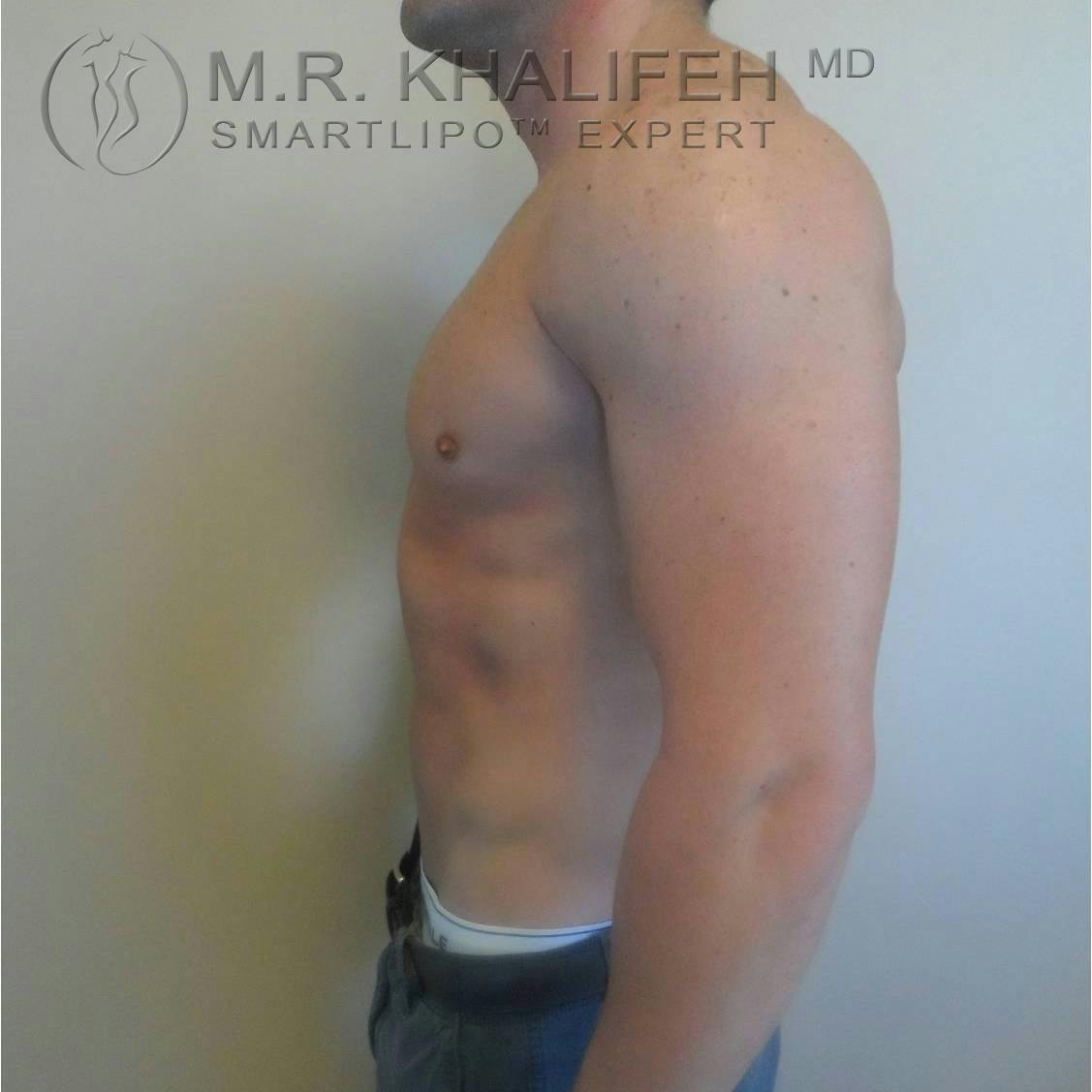 Male Liposuction Gallery - Patient 3776603 - Image 6