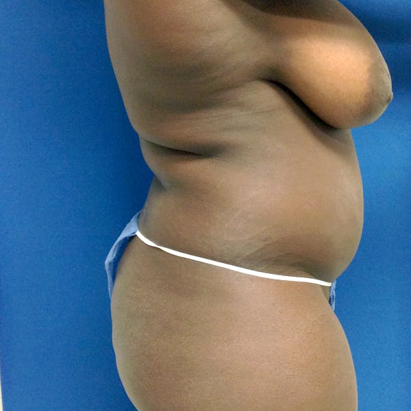 Abdominal Liposuction Gallery - Patient 3776647 - Image 9