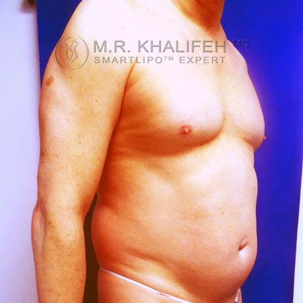 Male Liposuction Gallery - Patient 3776697 - Image 3