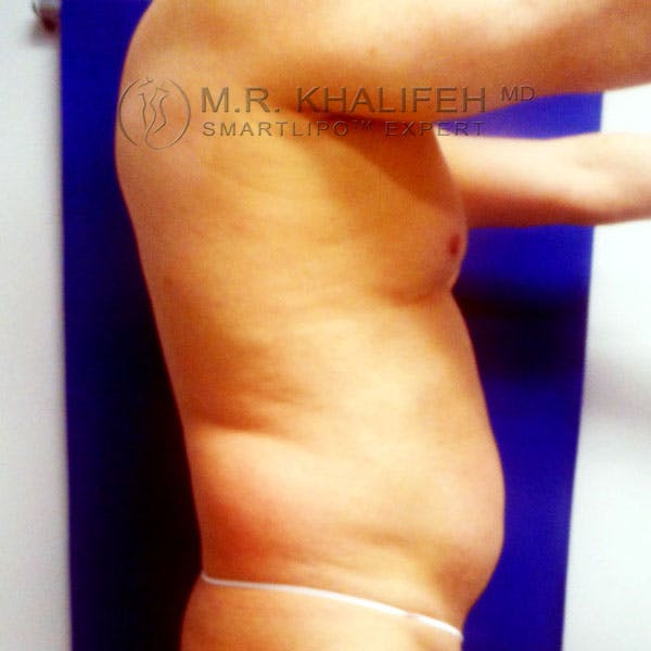 Male Liposuction Gallery - Patient 3776697 - Image 5