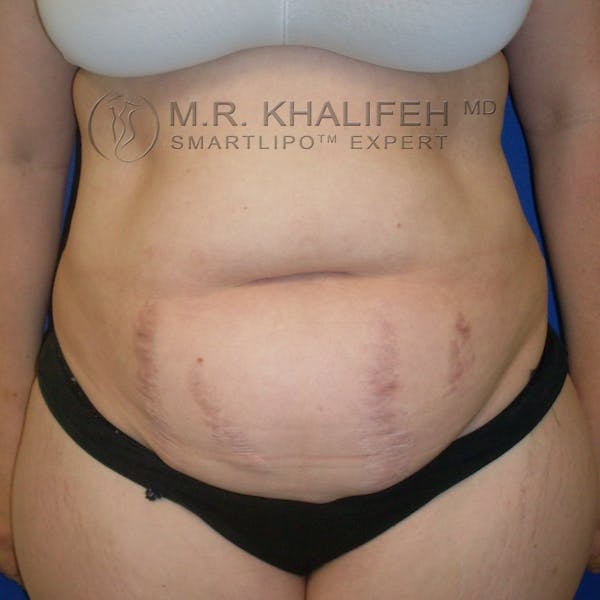 Abdominal Liposuction Gallery - Patient 3776737 - Image 1