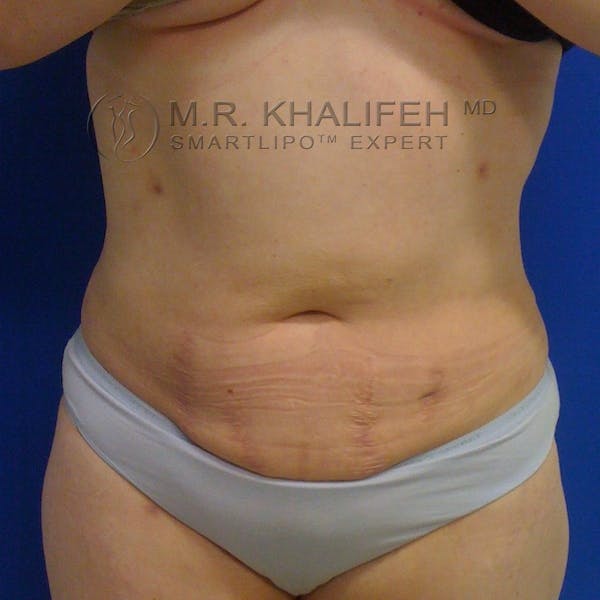 Abdominal Liposuction Gallery - Patient 3776737 - Image 2