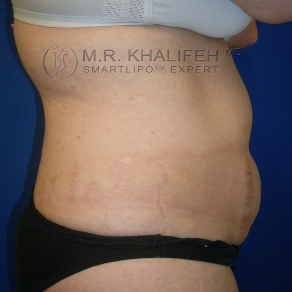 Abdominal Liposuction Gallery - Patient 3776737 - Image 3